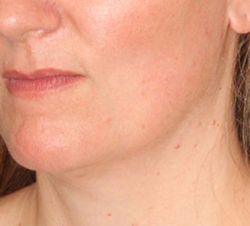 Neck Liposuction Before & After Gallery - Patient 106569396 - Image 5