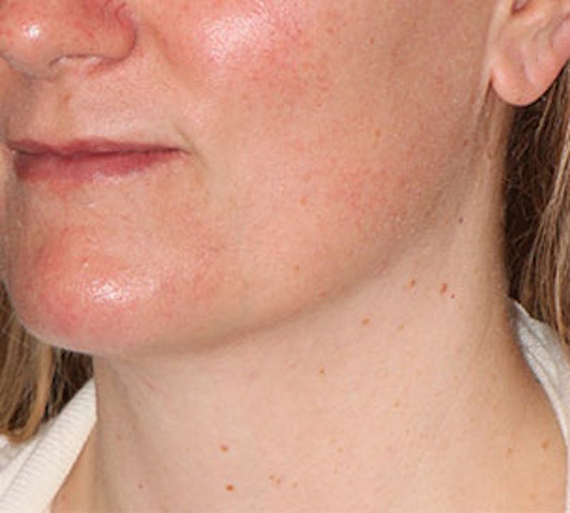 Neck Liposuction Before & After Gallery - Patient 106569396 - Image 6