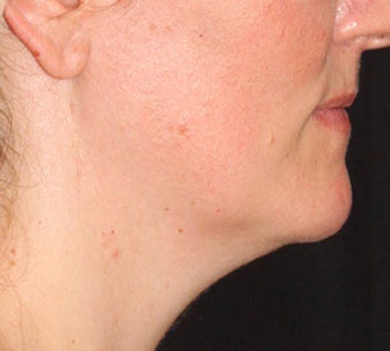 Neck Liposuction Before & After Gallery - Patient 106569396 - Image 7