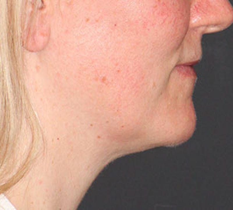Neck Liposuction Before & After Gallery - Patient 106569396 - Image 8