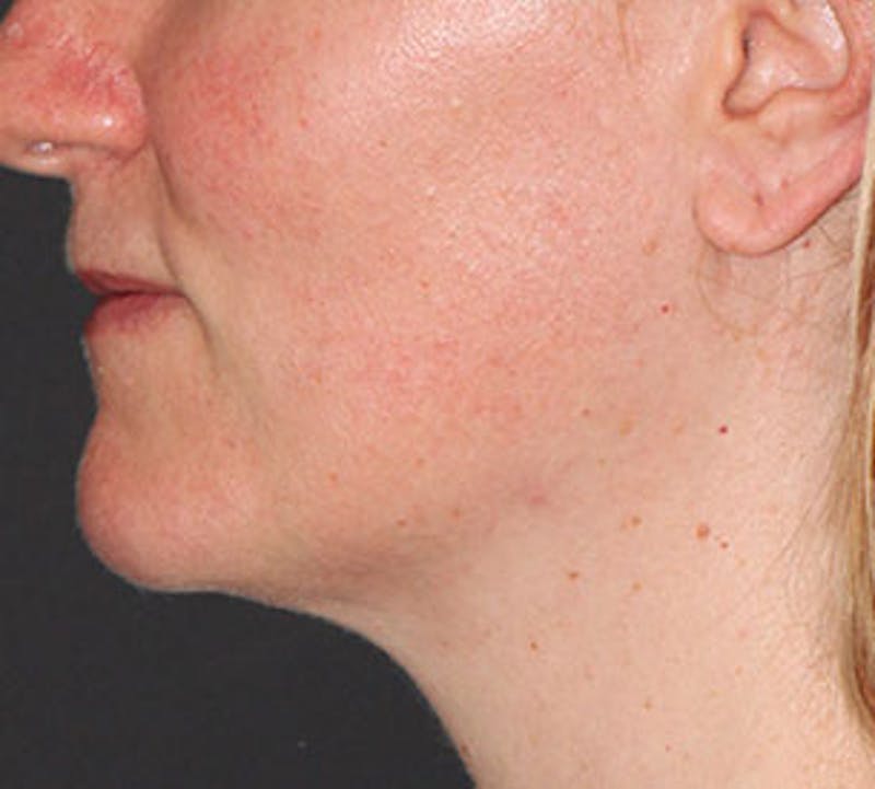 Neck Liposuction Before & After Gallery - Patient 106569396 - Image 10