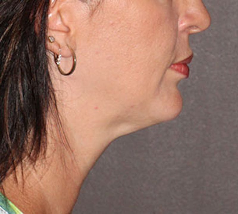 Neck Liposuction Before & After Gallery - Patient 106569399 - Image 8