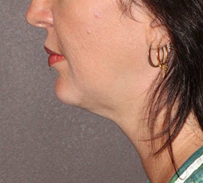 Neck Liposuction Before & After Gallery - Patient 106569399 - Image 10
