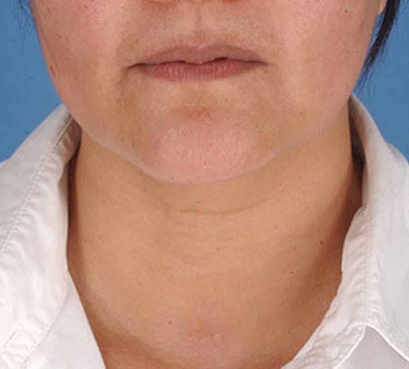 Neck Liposuction Before & After Gallery - Patient 106569404 - Image 1