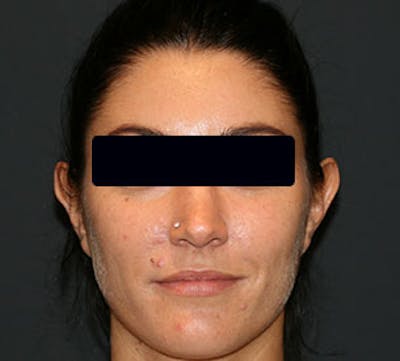 Otoplasty Before & After Gallery - Patient 106569433 - Image 1