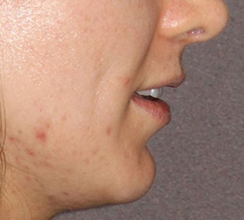 Lip Enhancement Before & After Gallery - Patient 106569527 - Image 9