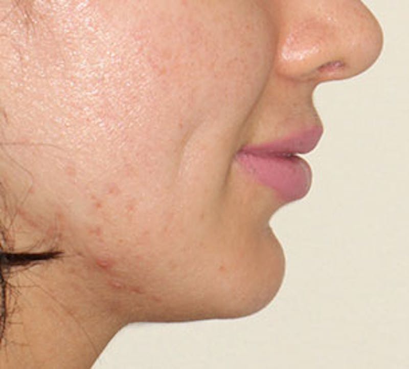 Lip Enhancement Before & After Gallery - Patient 106569527 - Image 10