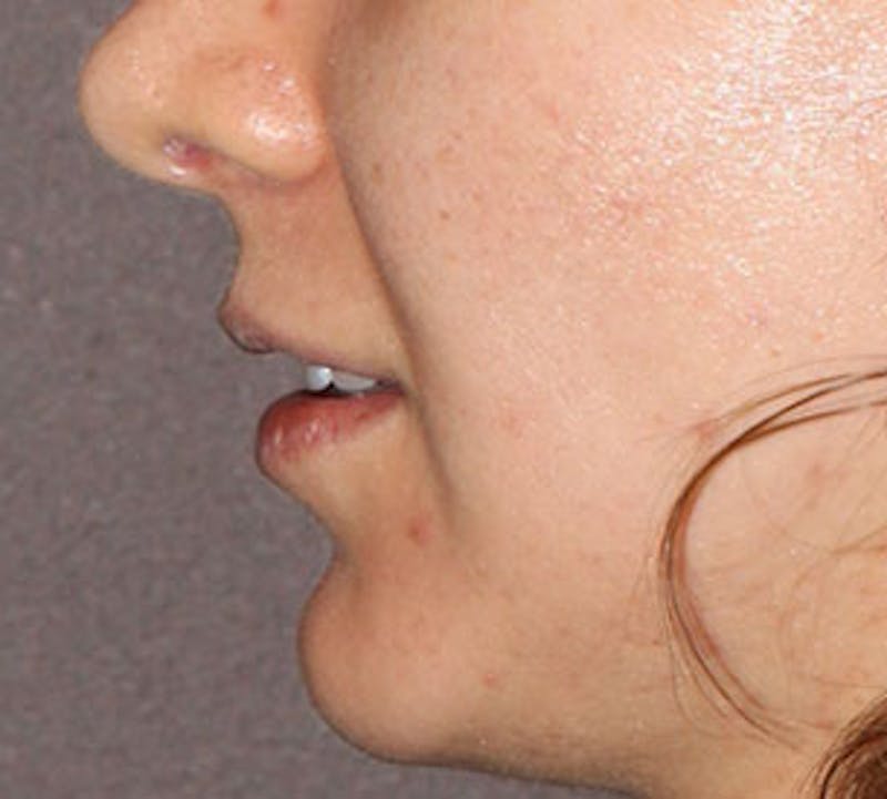Lip Enhancement Before & After Gallery - Patient 106569527 - Image 11