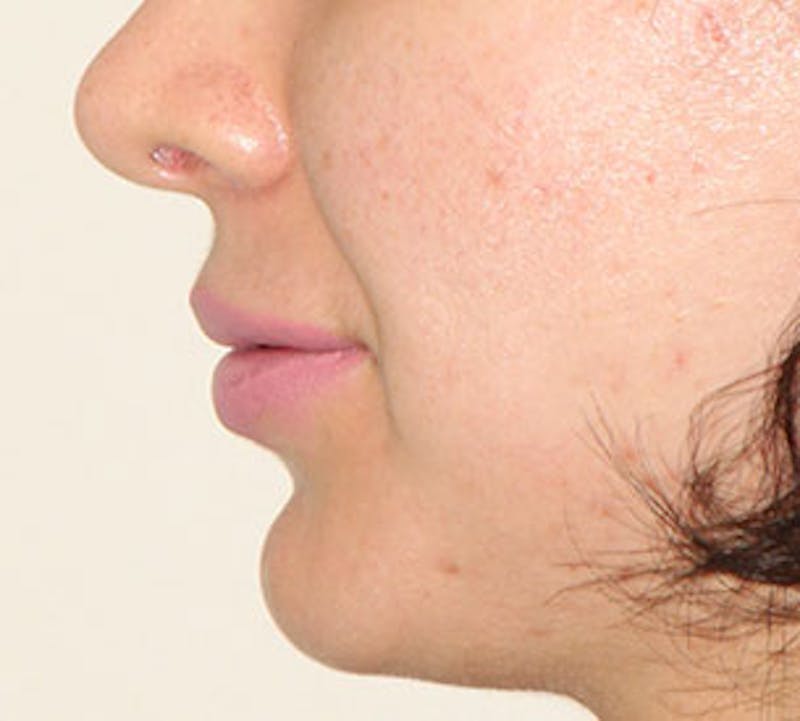 Lip Enhancement Before & After Gallery - Patient 106569527 - Image 12