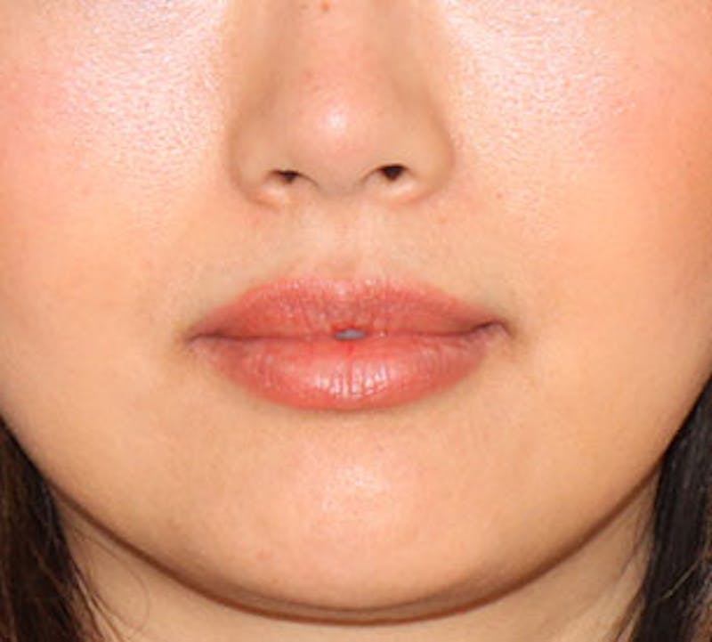 Lip Enhancement Before & After Gallery - Patient 106569528 - Image 2