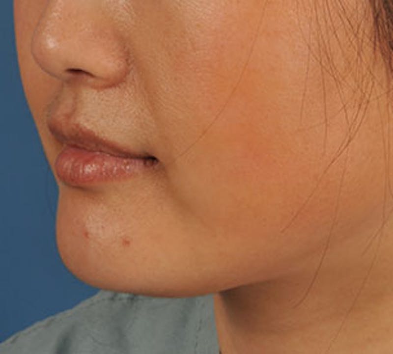 Lip Enhancement Before & After Gallery - Patient 106569528 - Image 5