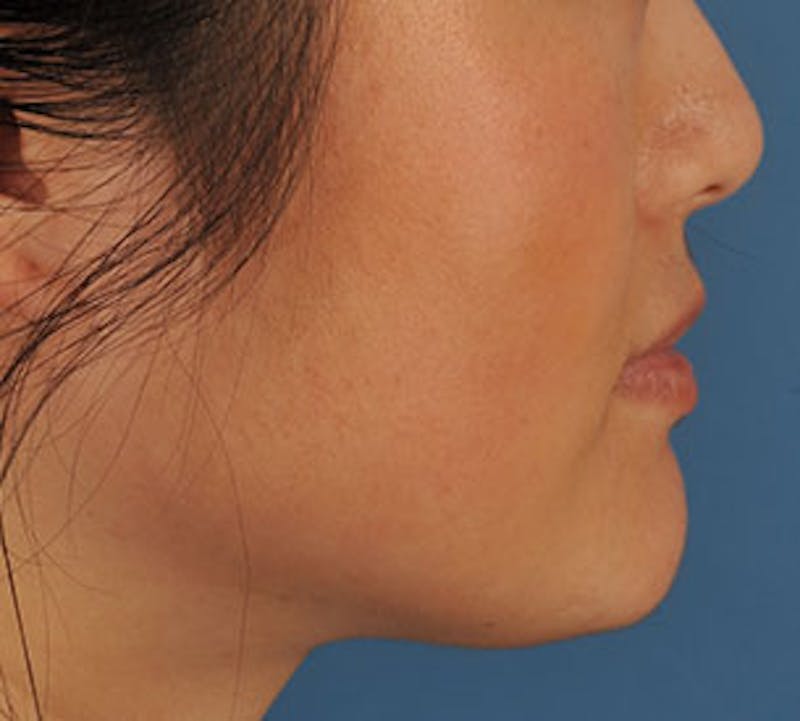 Lip Enhancement Before & After Gallery - Patient 106569528 - Image 7