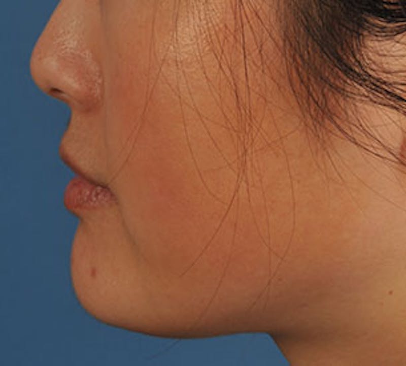 Lip Enhancement Before & After Gallery - Patient 106569528 - Image 9