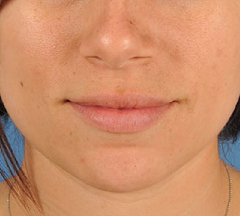 Lip Enhancement Before & After Gallery - Patient 106569534 - Image 1