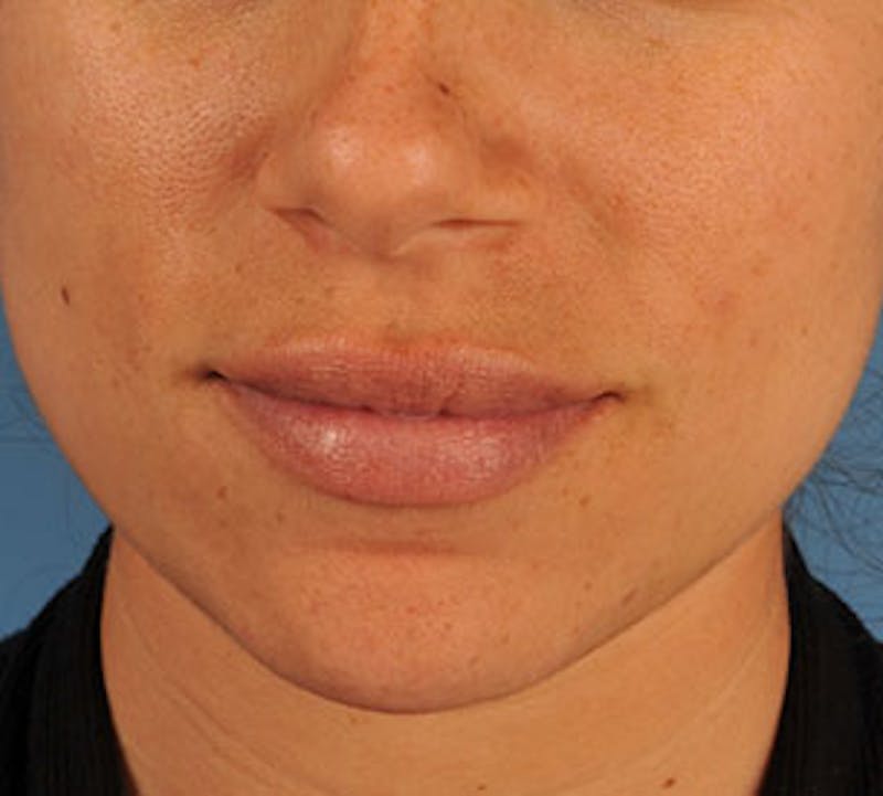 Lip Enhancement Before & After Gallery - Patient 106569534 - Image 2