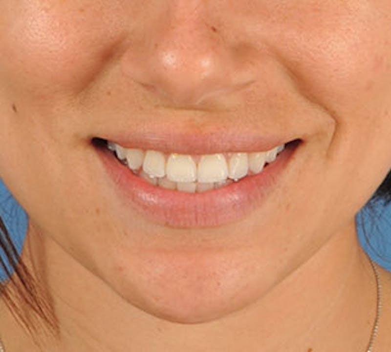 Lip Enhancement Before & After Gallery - Patient 106569534 - Image 3