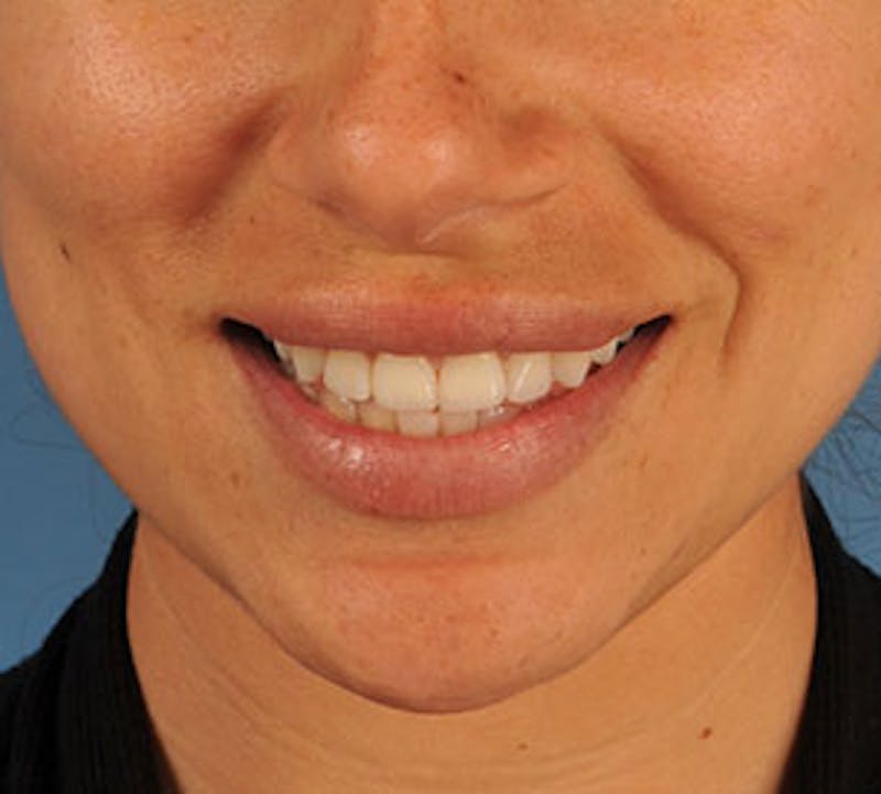 Lip Enhancement Before & After Gallery - Patient 106569534 - Image 4