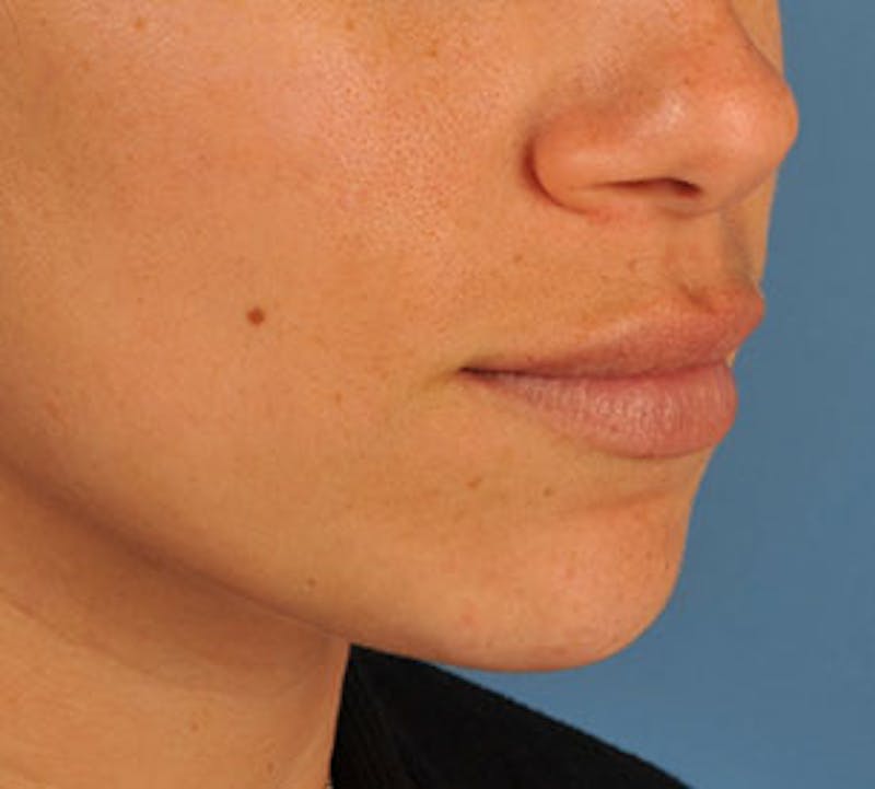 Lip Enhancement Before & After Gallery - Patient 106569534 - Image 6