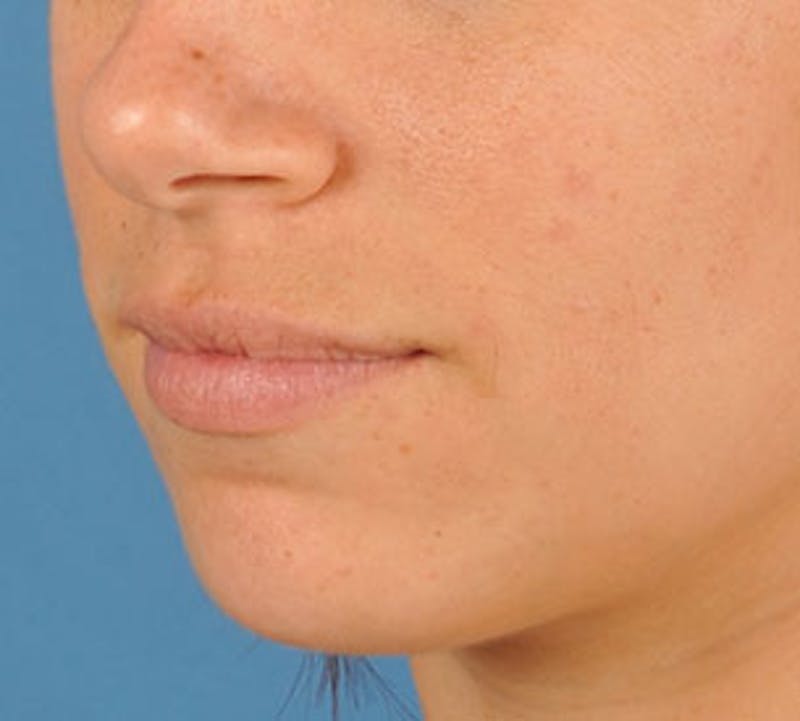 Lip Enhancement Before & After Gallery - Patient 106569534 - Image 7