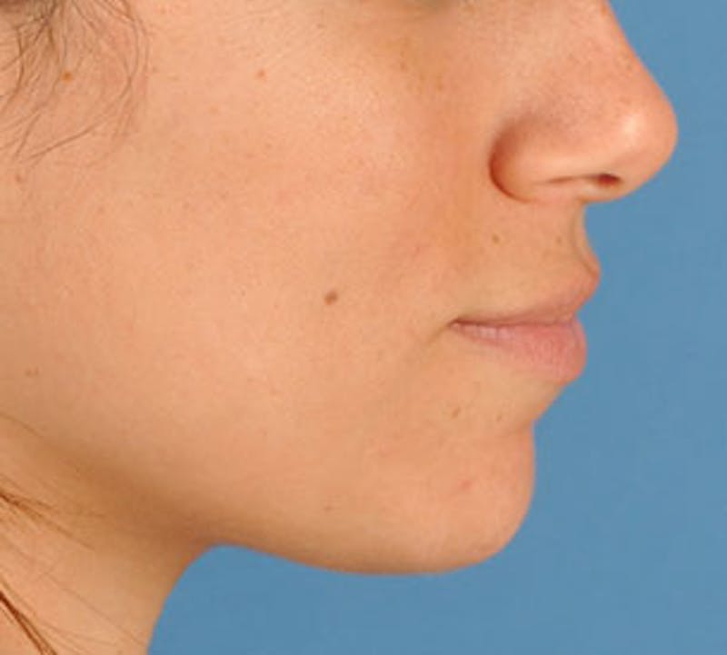 Lip Enhancement Before & After Gallery - Patient 106569534 - Image 9