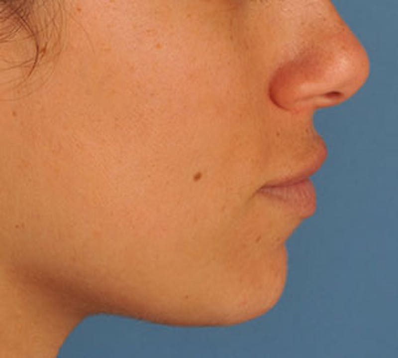 Lip Enhancement Before & After Gallery - Patient 106569534 - Image 10