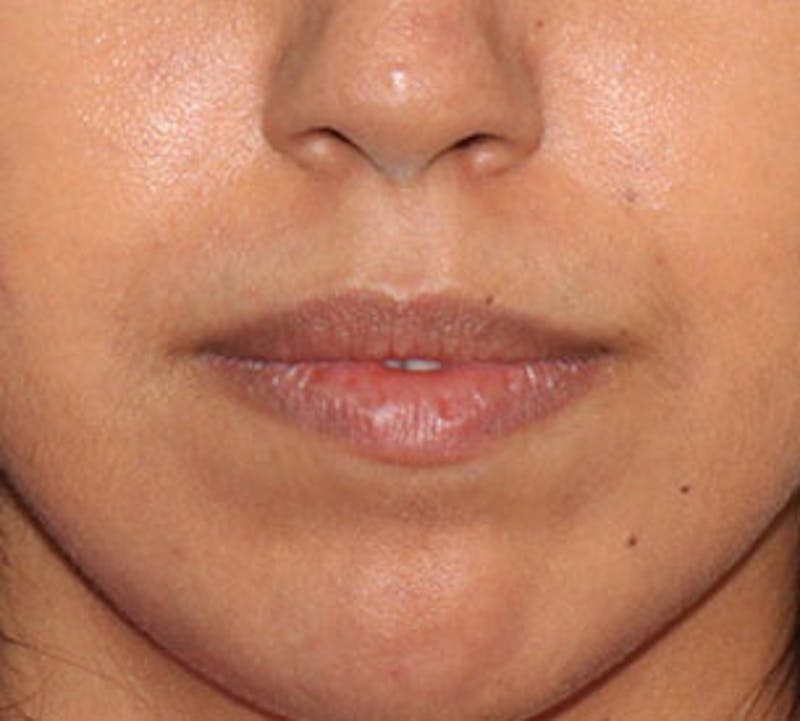 Lip Enhancement Before & After Gallery - Patient 106569539 - Image 3