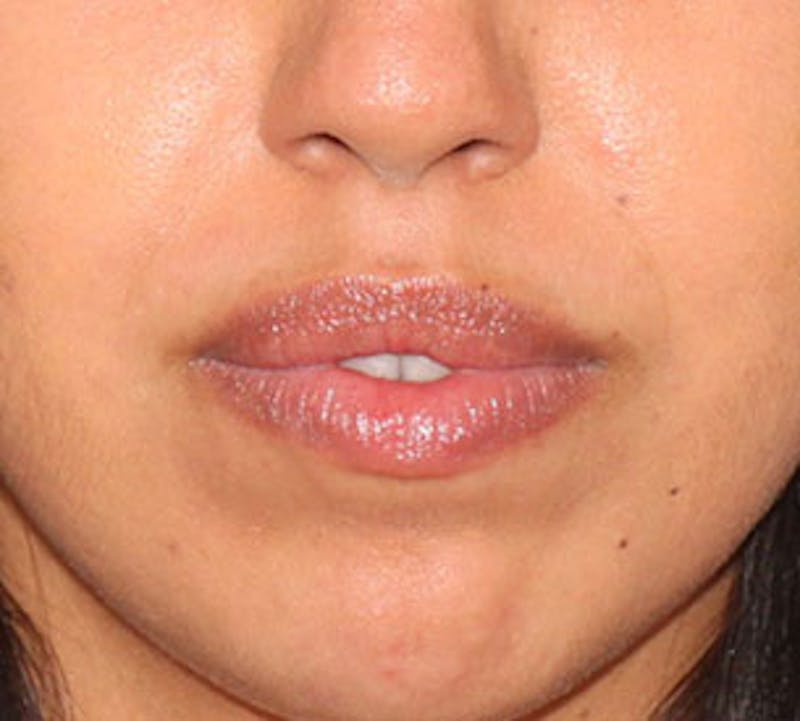 Lip Enhancement Before & After Gallery - Patient 106569539 - Image 4
