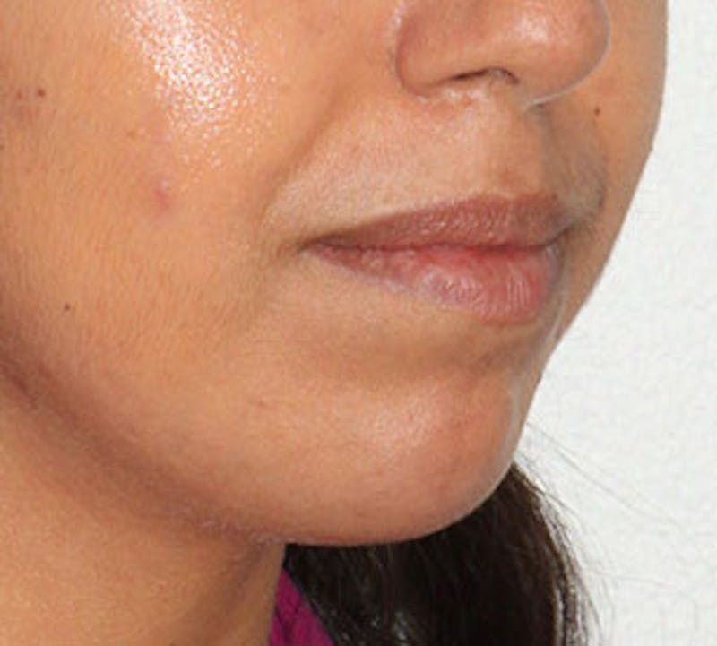 Lip Enhancement Before & After Gallery - Patient 106569539 - Image 5
