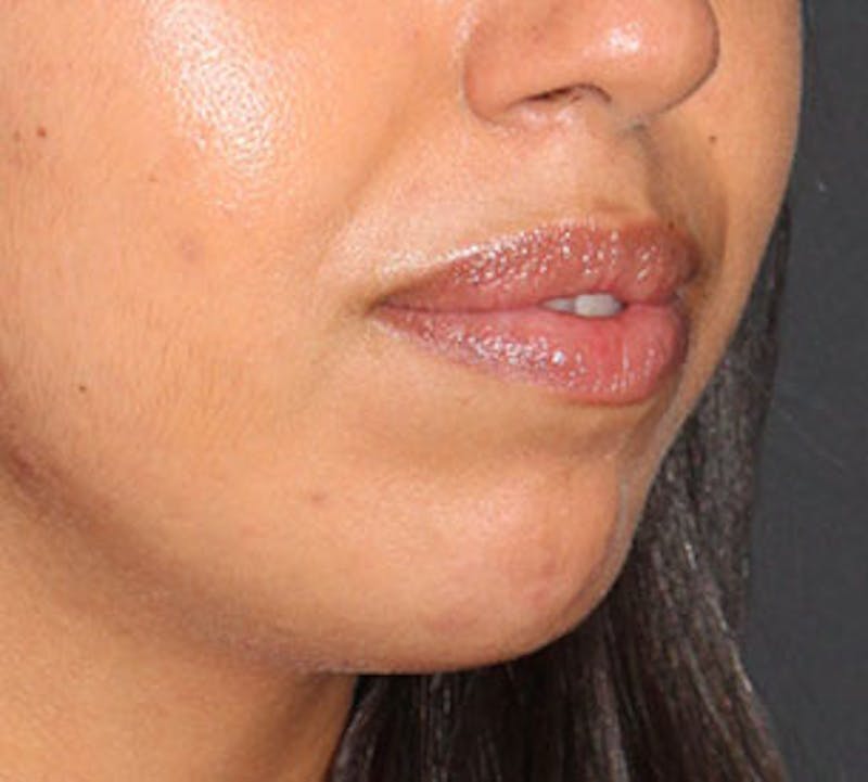 Lip Enhancement Before & After Gallery - Patient 106569539 - Image 6