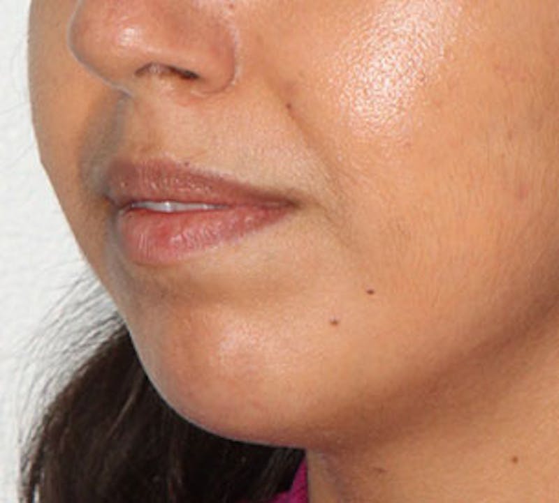 Lip Enhancement Before & After Gallery - Patient 106569539 - Image 7