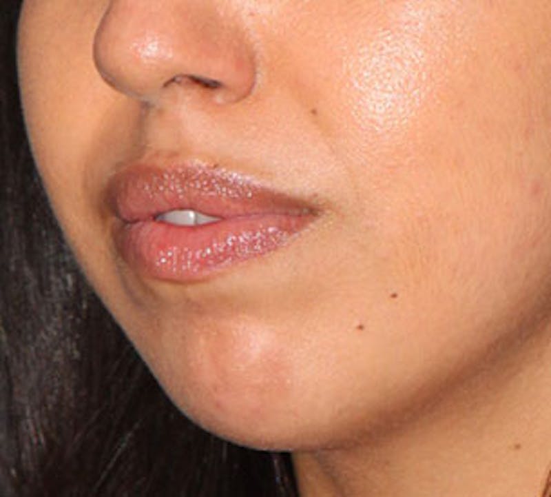 Lip Enhancement Before & After Gallery - Patient 106569539 - Image 8