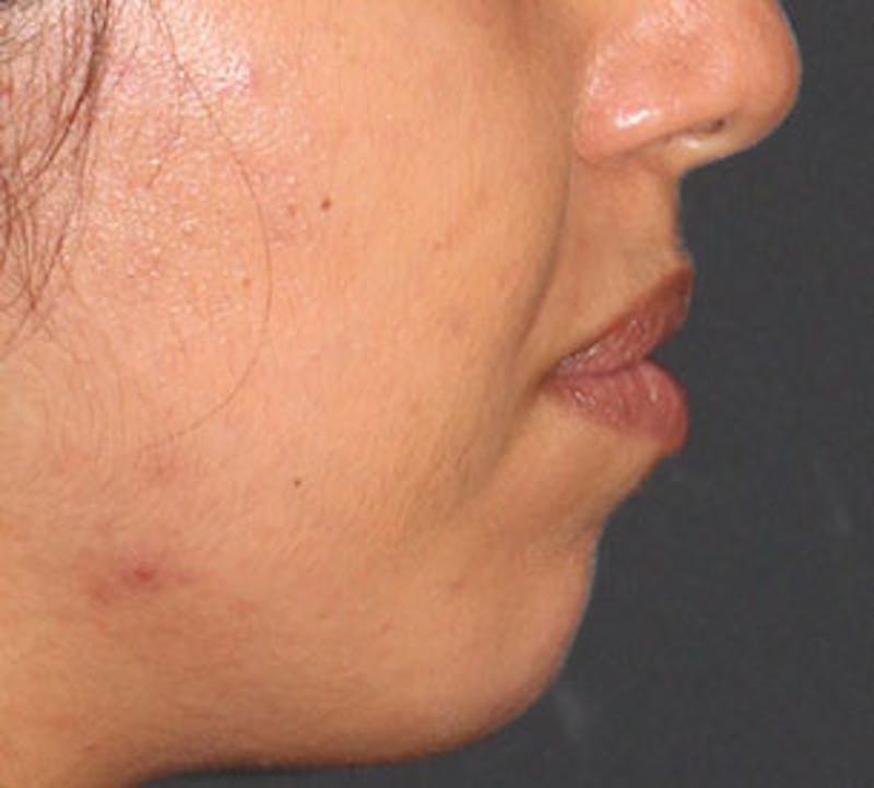 Lip Enhancement Before & After Gallery - Patient 106569539 - Image 10