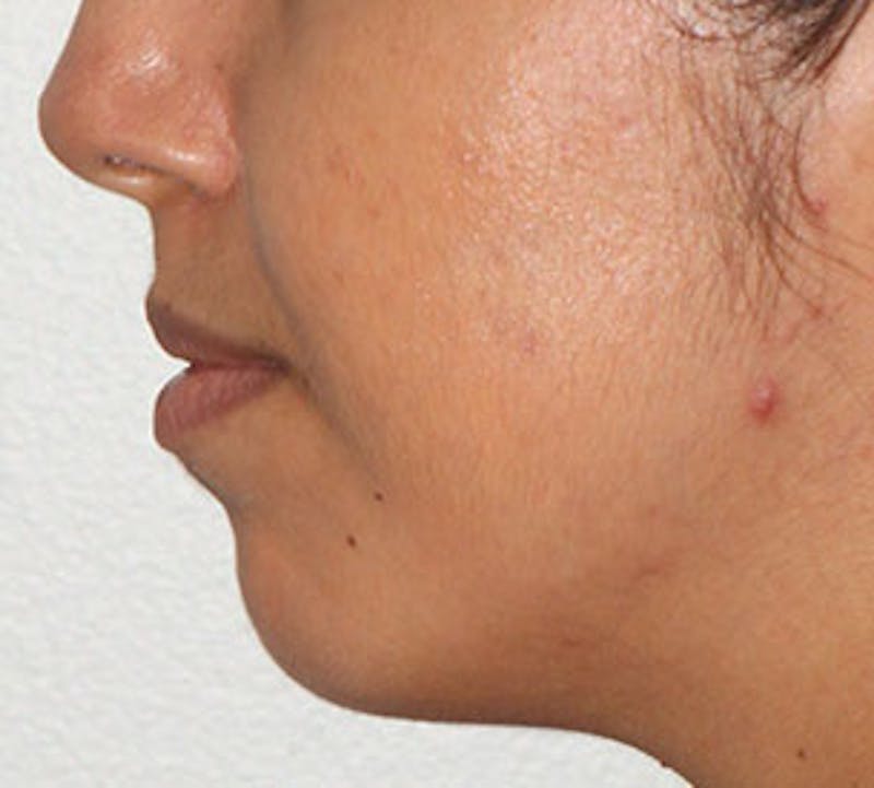 Lip Enhancement Before & After Gallery - Patient 106569539 - Image 11