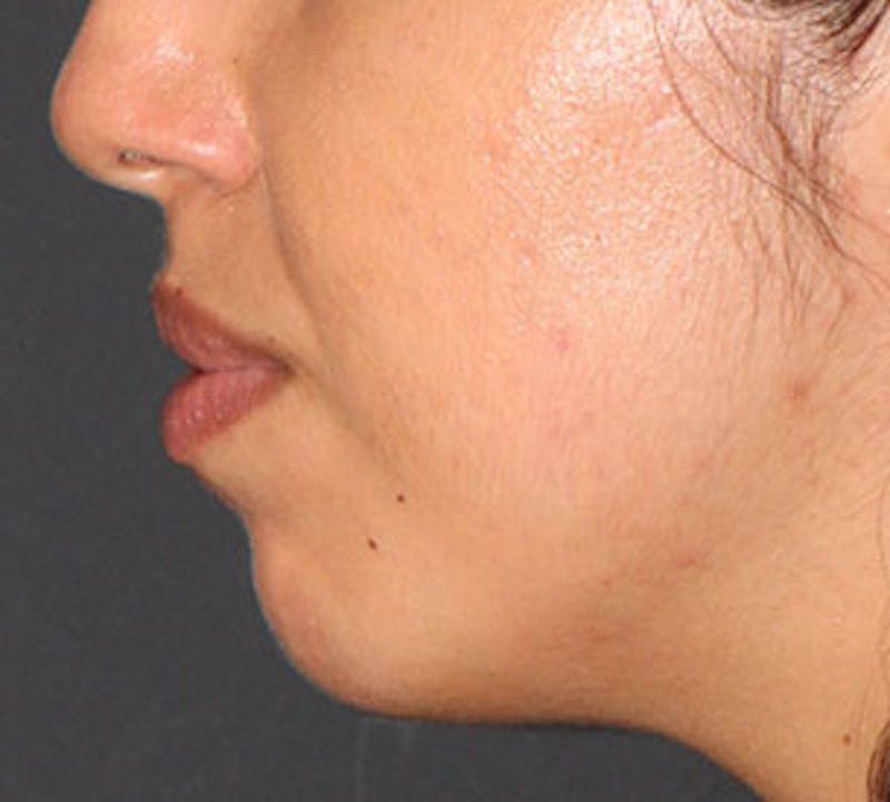 Lip Enhancement Before & After Gallery - Patient 106569539 - Image 12