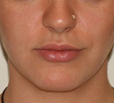 Lip Enhancement Before & After Gallery - Patient 106569590 - Image 1