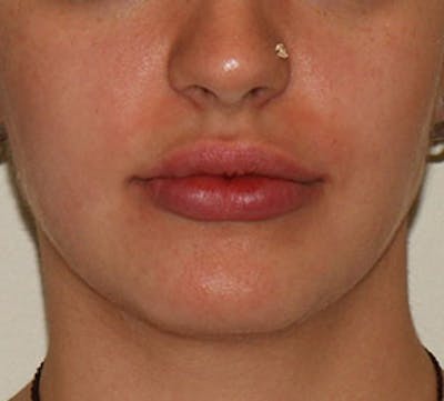 Lip Enhancement Before & After Gallery - Patient 106569590 - Image 2