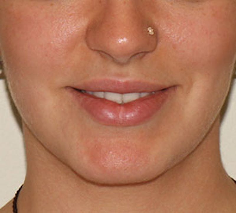 Lip Enhancement Before & After Gallery - Patient 106569590 - Image 3