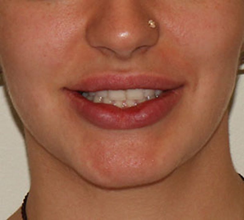 Lip Enhancement Before & After Gallery - Patient 106569590 - Image 4