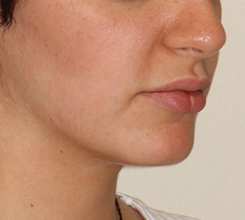 Lip Enhancement Before & After Gallery - Patient 106569590 - Image 5