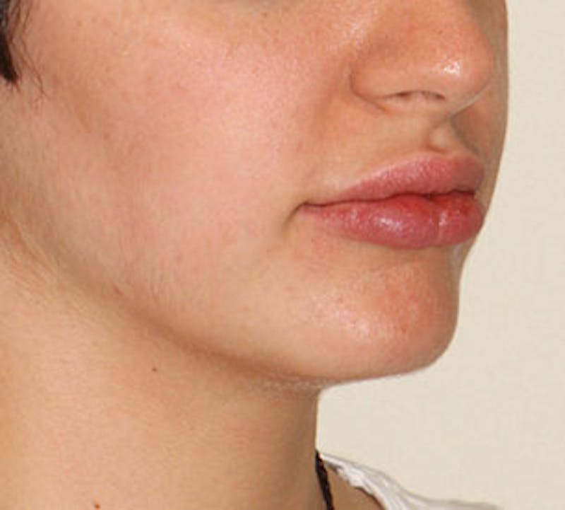 Lip Enhancement Before & After Gallery - Patient 106569590 - Image 6
