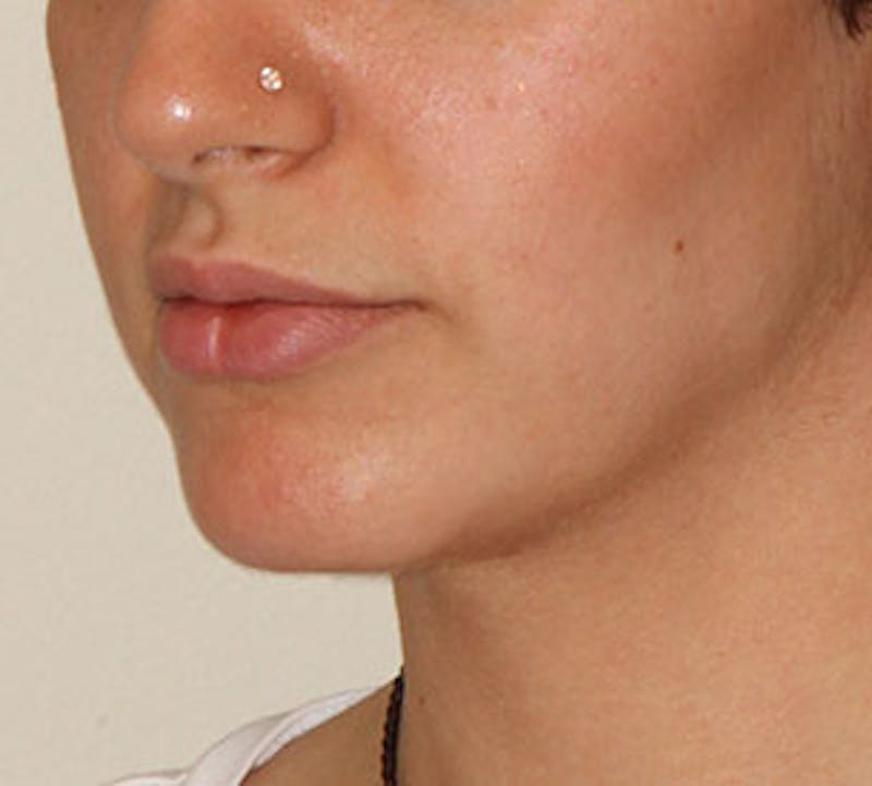 Lip Enhancement Before & After Gallery - Patient 106569590 - Image 7