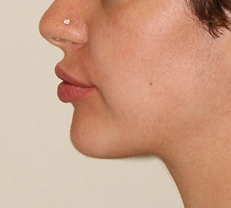 Lip Enhancement Before & After Gallery - Patient 106569590 - Image 12