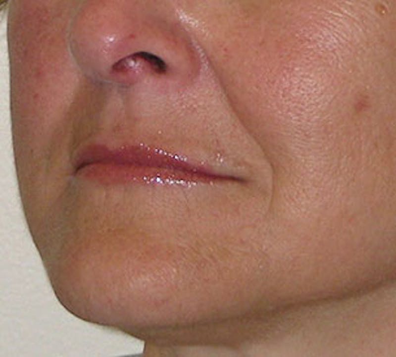 Lip Enhancement Before & After Gallery - Patient 106569618 - Image 8