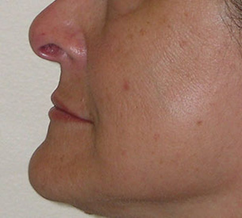 Lip Enhancement Before & After Gallery - Patient 106569618 - Image 12