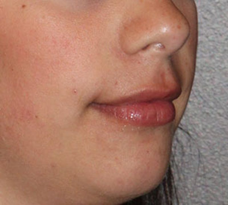 Lip Enhancement Before & After Gallery - Patient 106569620 - Image 5