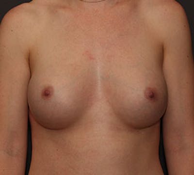 Breast Augmentation Before & After Gallery - Patient 106572863 - Image 2