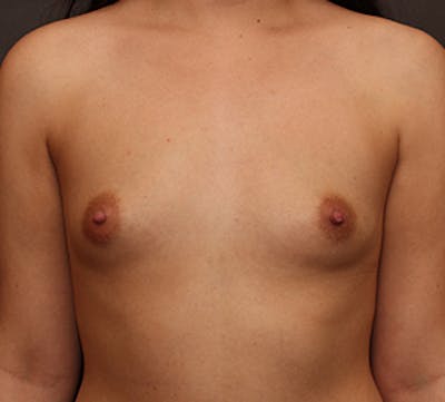 Breast Augmentation Before & After Gallery - Patient 106572864 - Image 1