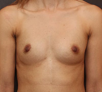 Breast Augmentation Before & After Gallery - Patient 106572886 - Image 1