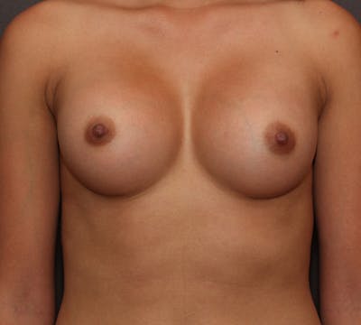 Breast Augmentation Before & After Gallery - Patient 106583003 - Image 2