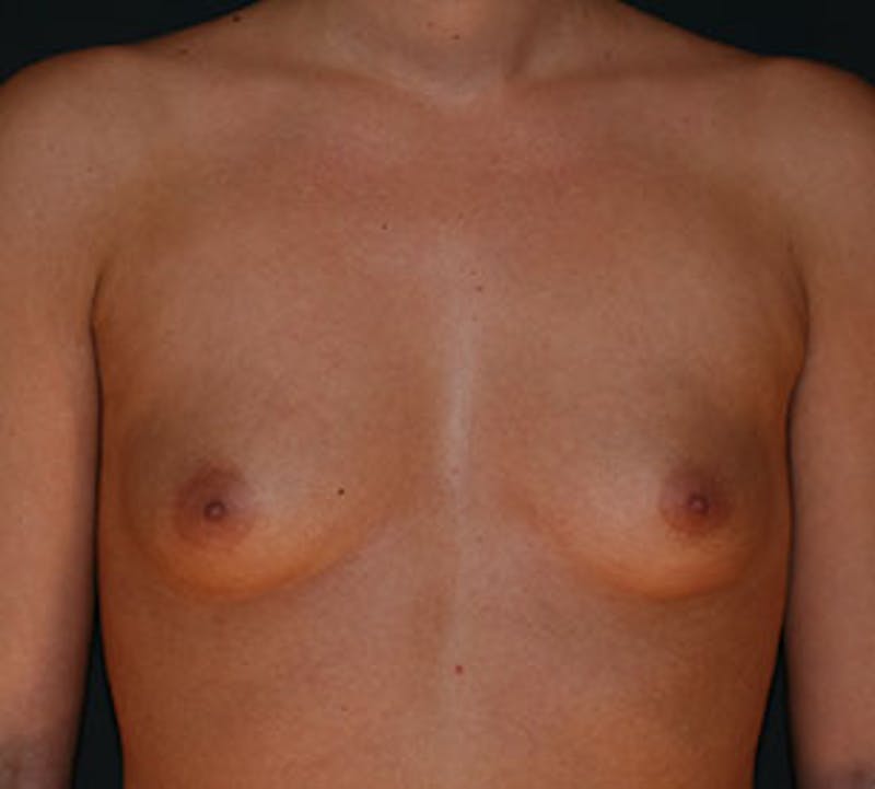 Breast Augmentation Before & After Gallery - Patient 106583054 - Image 1